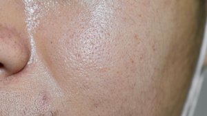 Perbedaan kulit dehidrasi dan kulit berminyak