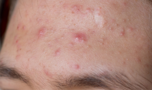 penyebab kulit berminyak dan berjerawat