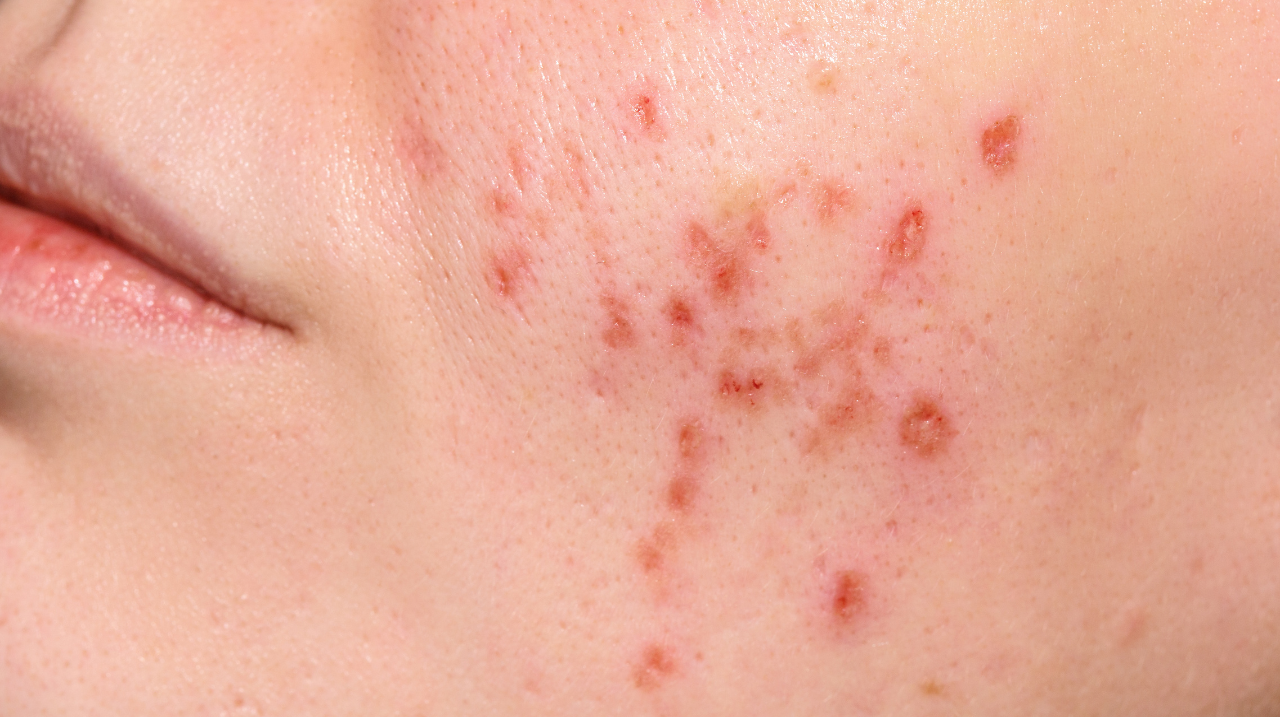 penyebab skin barrier rusak