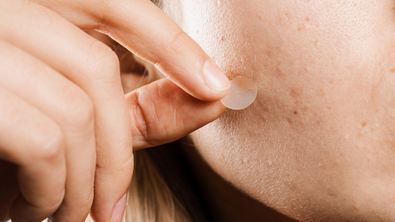 Menggunakan acne patch untuk jerawat
