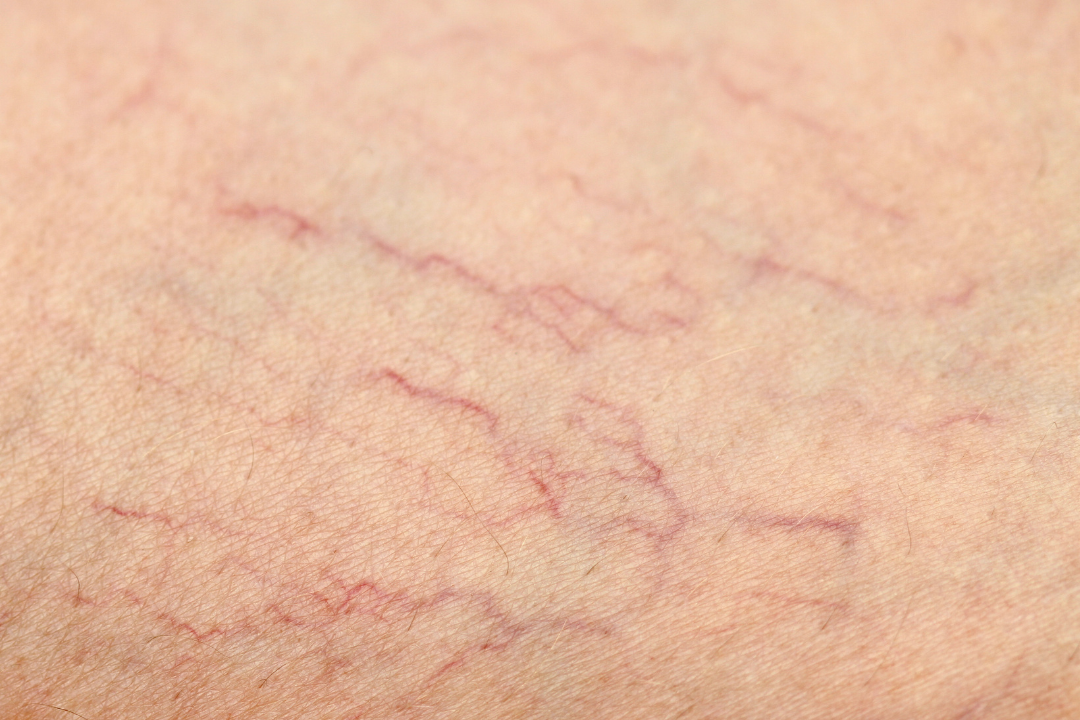Spider vein di wajah