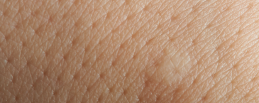 Mengapa Bisa Ada Ingrown Hair di Kulit?