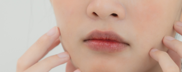 Saat Area Sekitar Mulut Terus Bermasalah, Belum Tentu Jerawat: Kenali Perioral Dermatitis