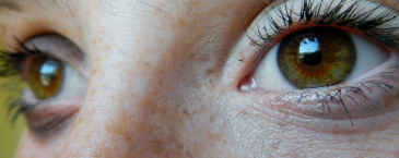 Mengapa Freckles Bisa Muncul pada Kulit?