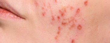 Ketahui Alasan Mengapa Skin Barrier Bisa Rusak