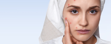 Kulit Bruntusan Setelah Pakai Skincare Baru? Cek Beberapa Hal Ini!