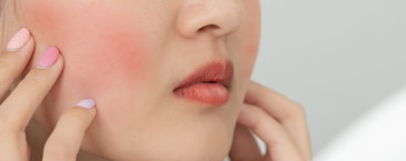 Tidak Semua Kemerahan di Wajah Adalah Jerawat: Kenali Perbedaan Rosacea dan Jerawat
